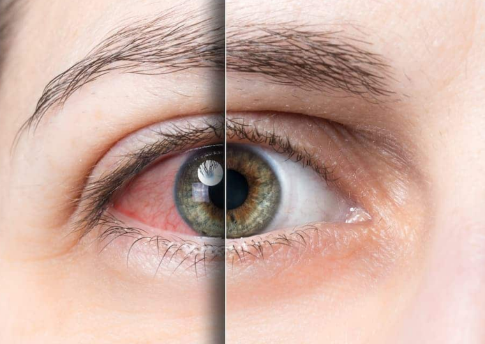 Does vaping change your eyes
